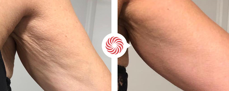 Bioslimming-voor-na-2