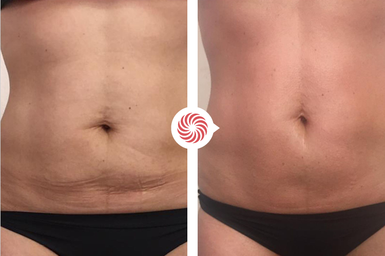 Bioslimming-voor-na-3